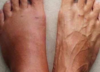 Hier sind die 6 Symptome