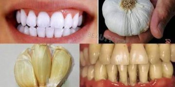 Geheimnisse, die Zahnärzte vor Ihnen verbergen möchten: Mit Knoblauch können Sie in nur 2 Minuten Zahnstein entfernen und Ihre Zähne aufhellen