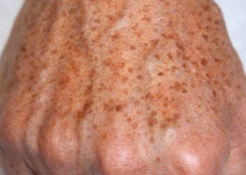 Warum bilden sich Flecken auf den Händen und wie kann man sie entfernen?