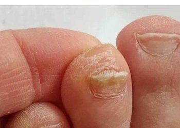 Der Trick zur Reduzierung der Zehennageldicke